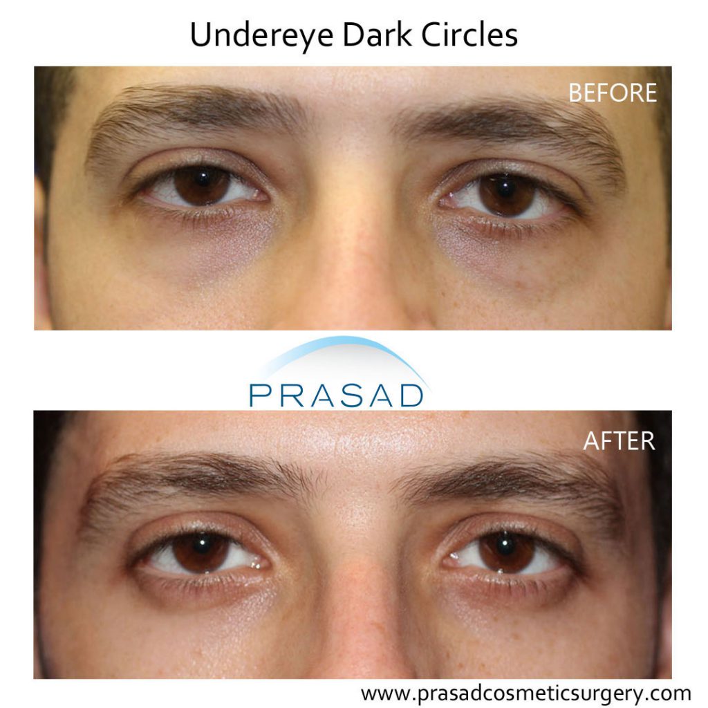 PRP treatment for dark under eye circles before and after results on male patient