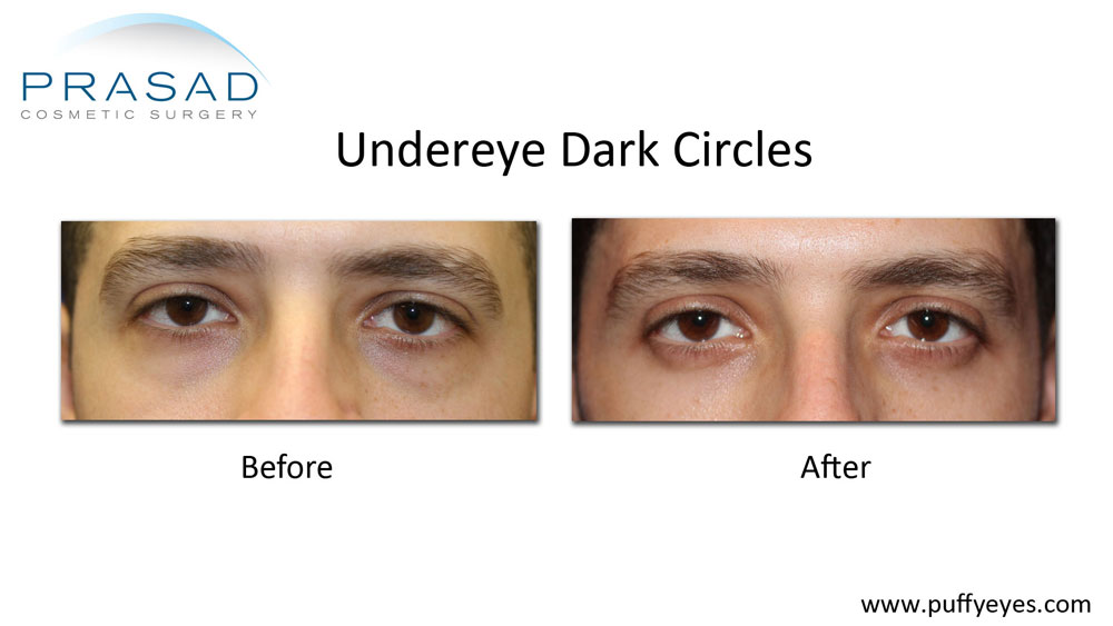 PRP treatment for dark under eye circles before and after results on male patient