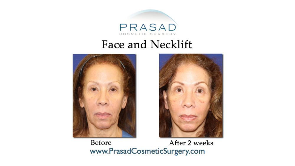 before and after deep plane face and neck lift