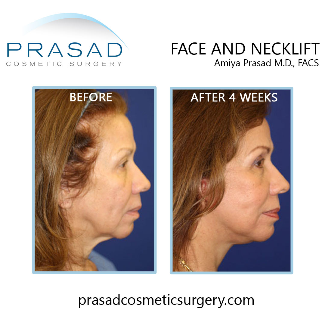 deep plane face and necklift patient before and after 4 weeks recovery - patient side view