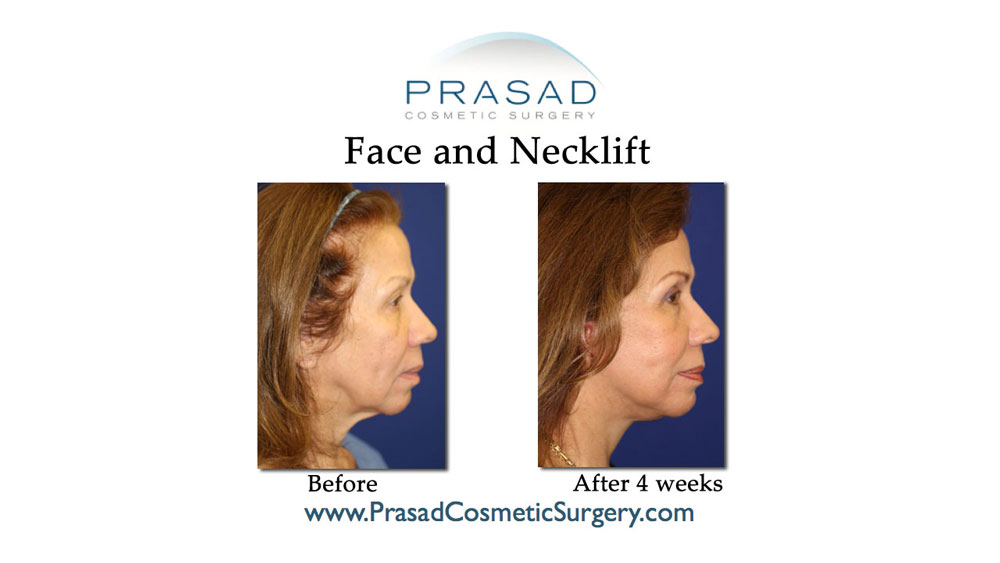 before and after face and necklift side view of female patient in 60s
