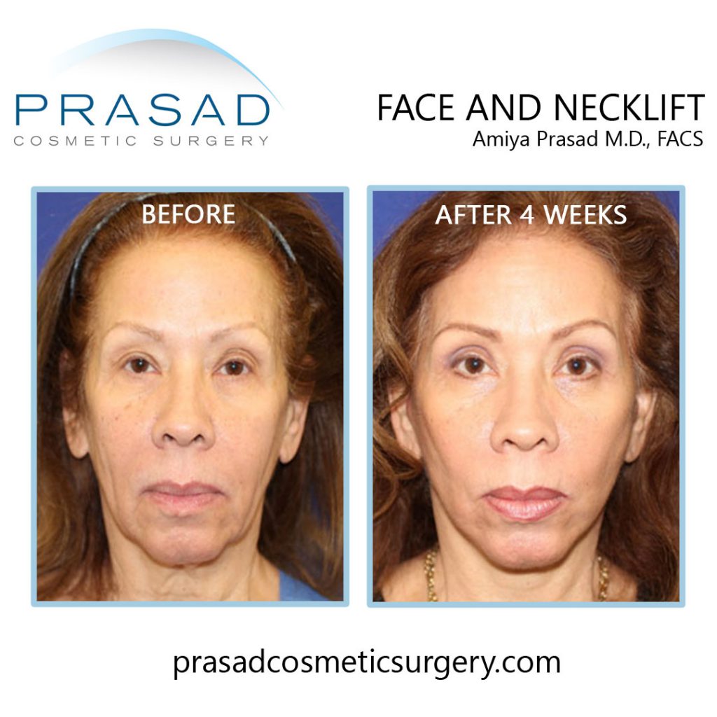 deep plane face and neck lift patient before and 4 weeks after surgery