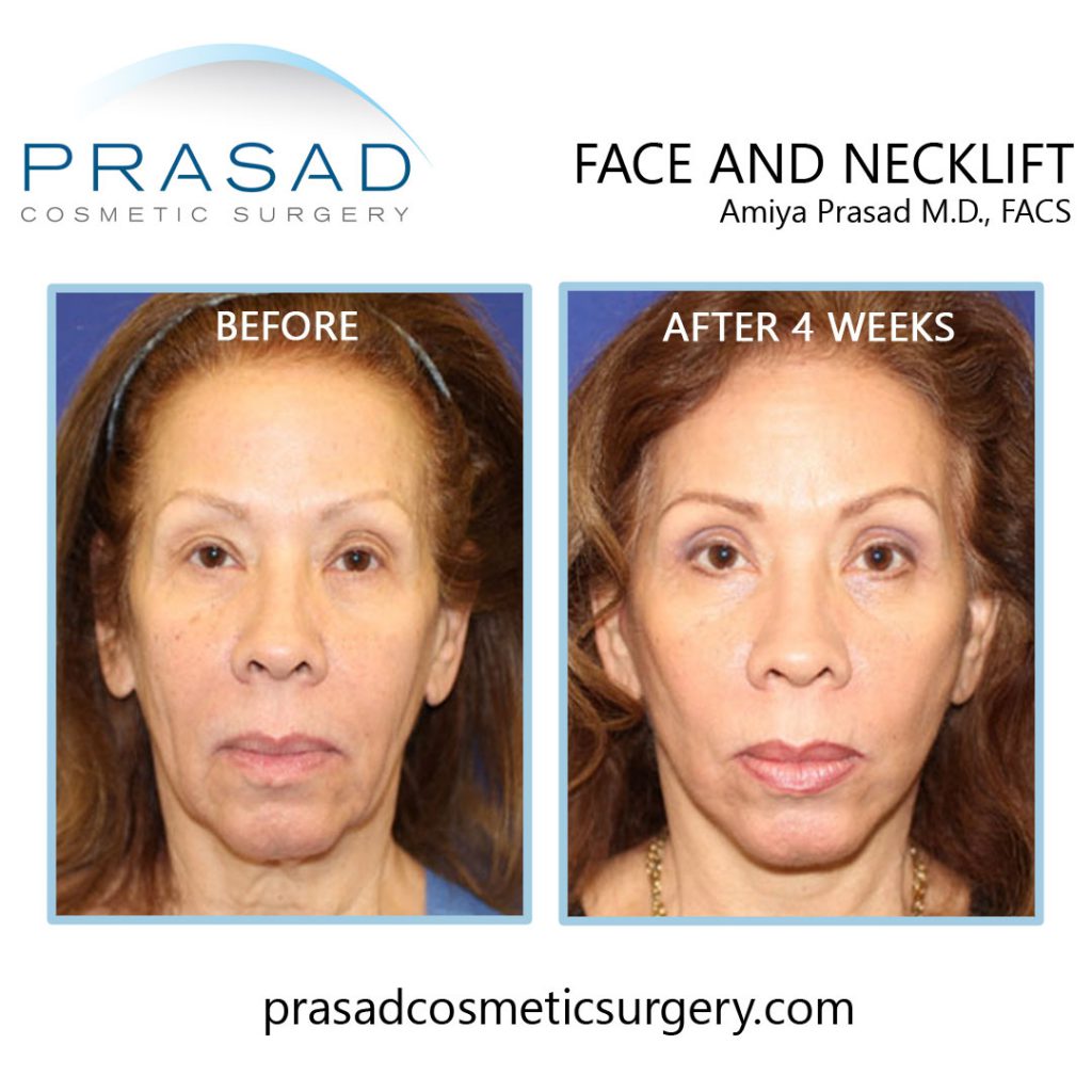 How to Choose the Best Neck Lift Procedure