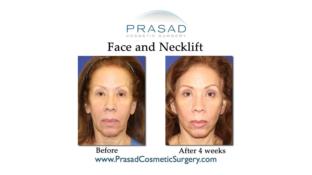 deep plane facelift before and after 4 weeks recovery Garden City New York