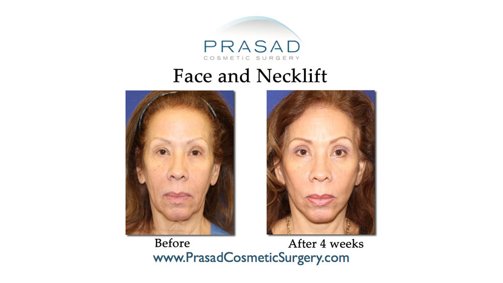 deep plane face and neck lift patient before and 4 weeks after surgery