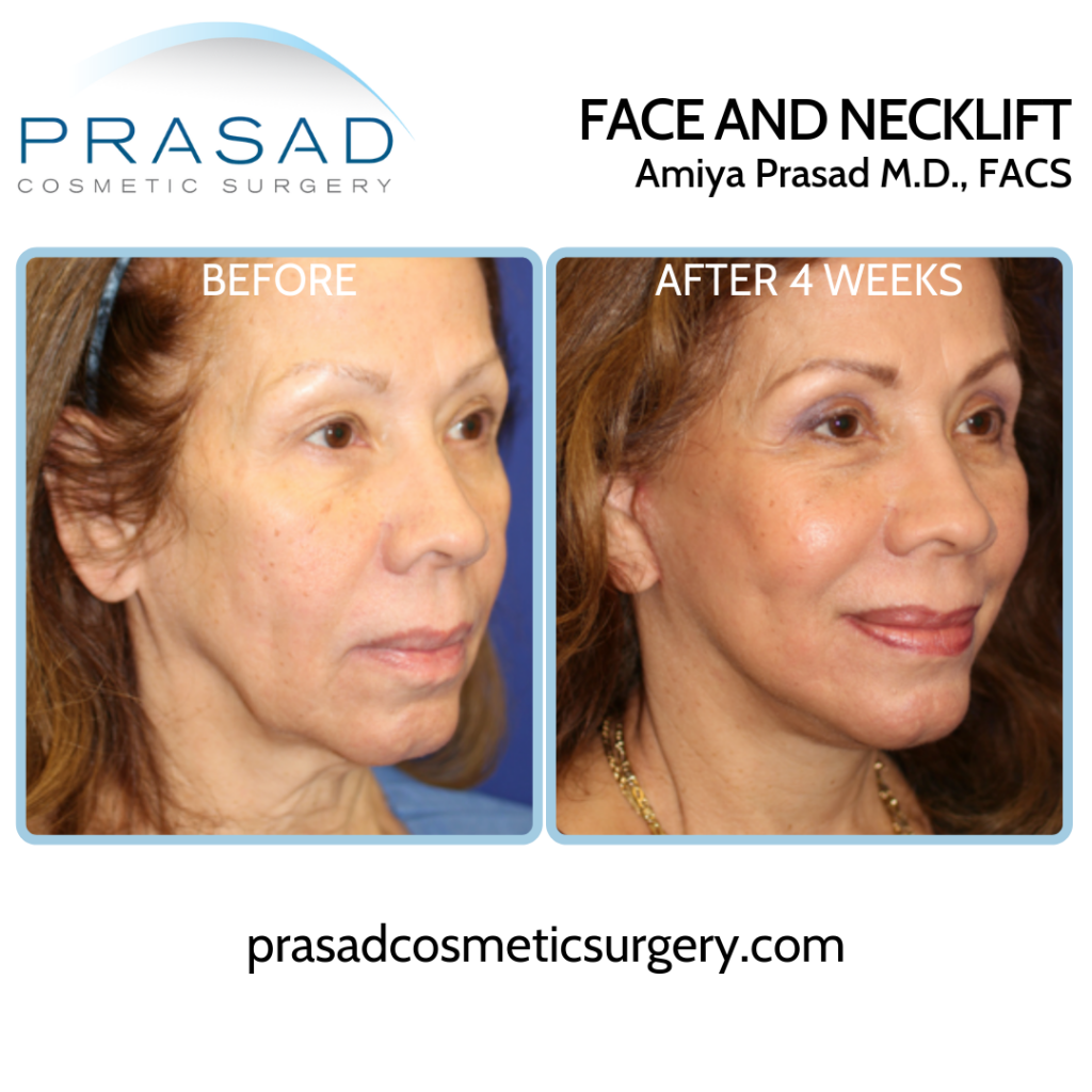 deep plane face and necklift patient before and after 4 weeks recovery.