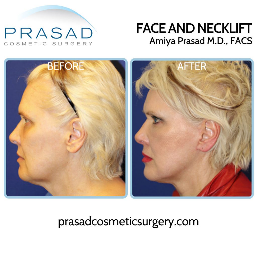 cosmetic surgery by Dr Amiya Prasad deep plane facelift before and after results