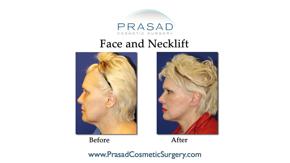 deep plane facelift before and after early 60s years old - left profile view