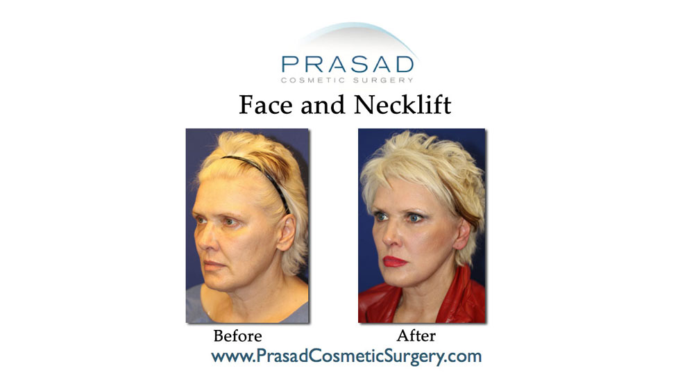 before and after face and neck lift female patient - quarter view