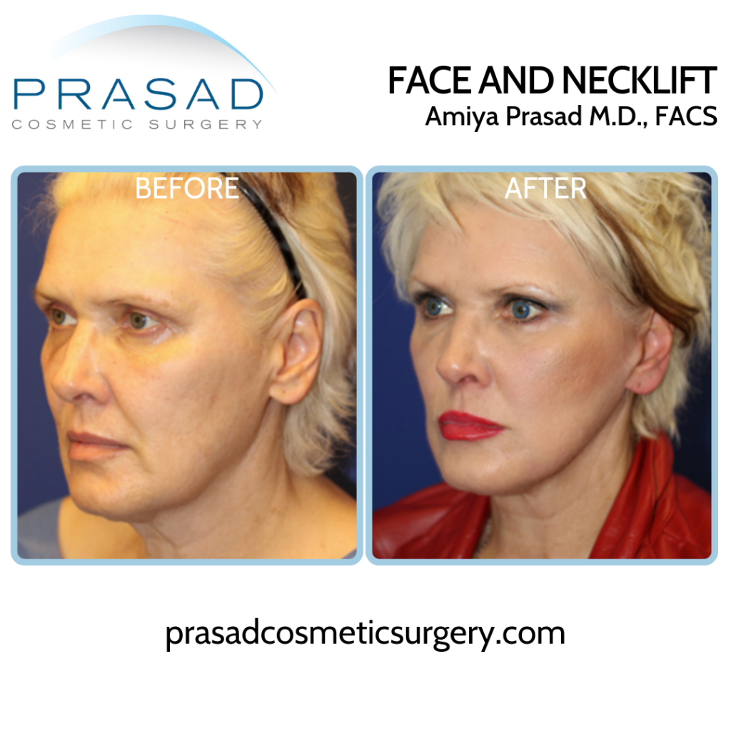 deep plane facelift patient before and after surgery results - three-quarter view