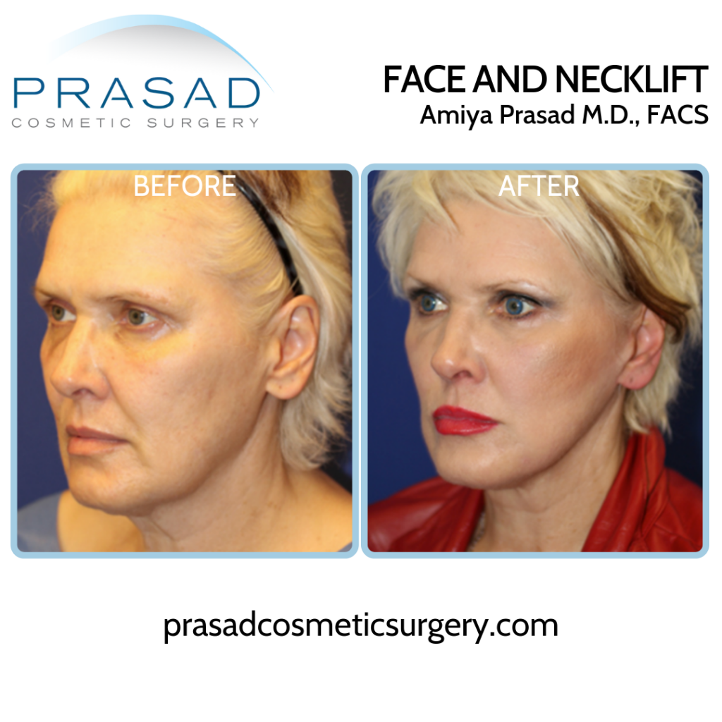 Considering a Facelift at 40? What You Need to Know