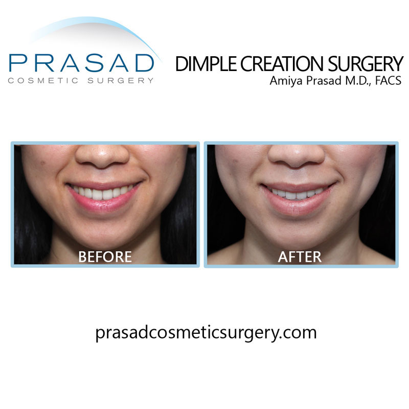 dimpleplasty before and after photo