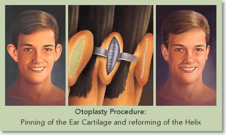 ear surgery procedure illustration