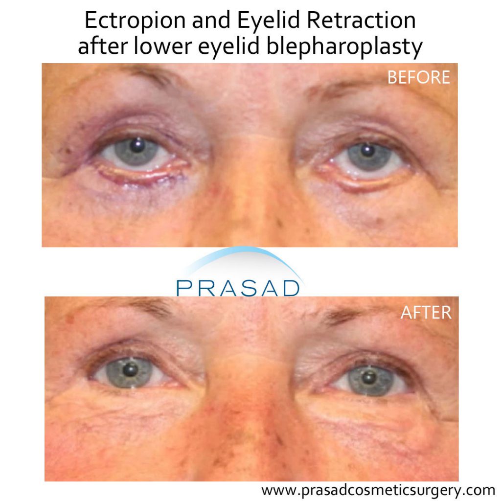 before and after blepharoplasty revision - older female patient