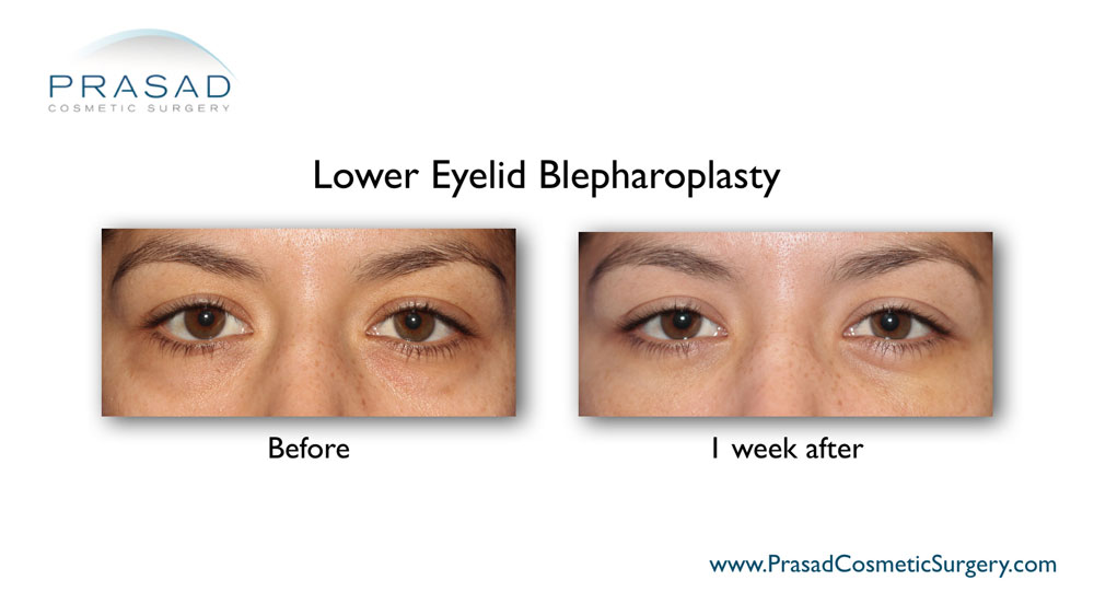 Under Eye Fillers Gone Wrong. What to Do? - Dr. Prasad Blog