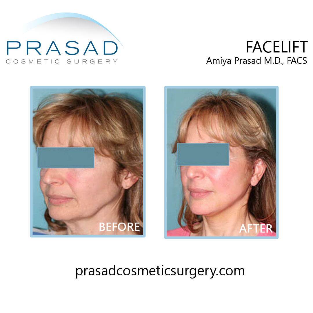 face lifts patient before and after results