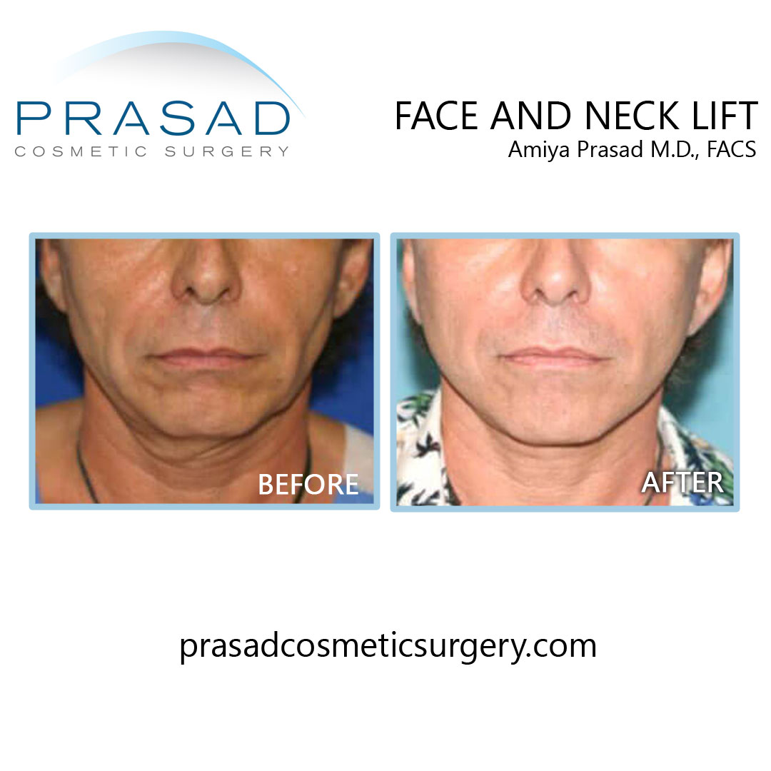 before and after face and neck lift procedure