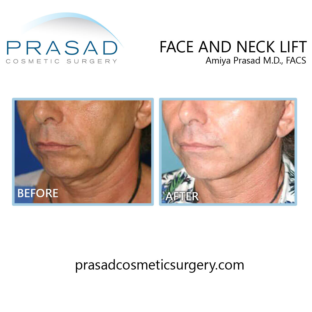 before and after face lifting surgery male patient