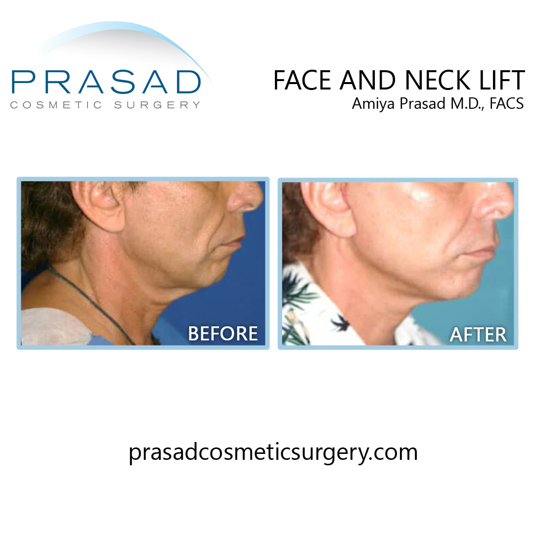 before and after results of face lifts performed by Dr Amiya Prasad USA