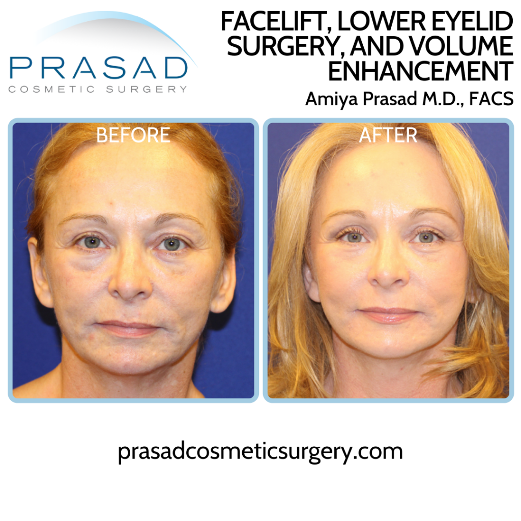 Under Eye Filler Before and After Photos - Prasad Cosmetic Surgery NY