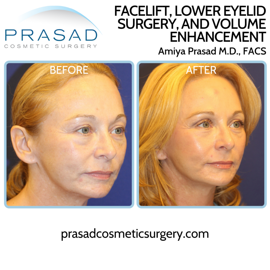 Facelift Patient Before and After in three-quarter view