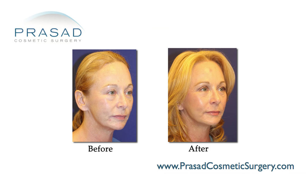 before and after facelift surgery on 50 yrs old female patient left quarter view