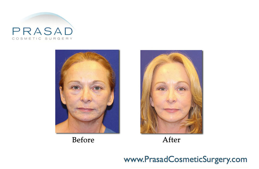 Facial Plastic Surgery, Bandage after a laser face lift and