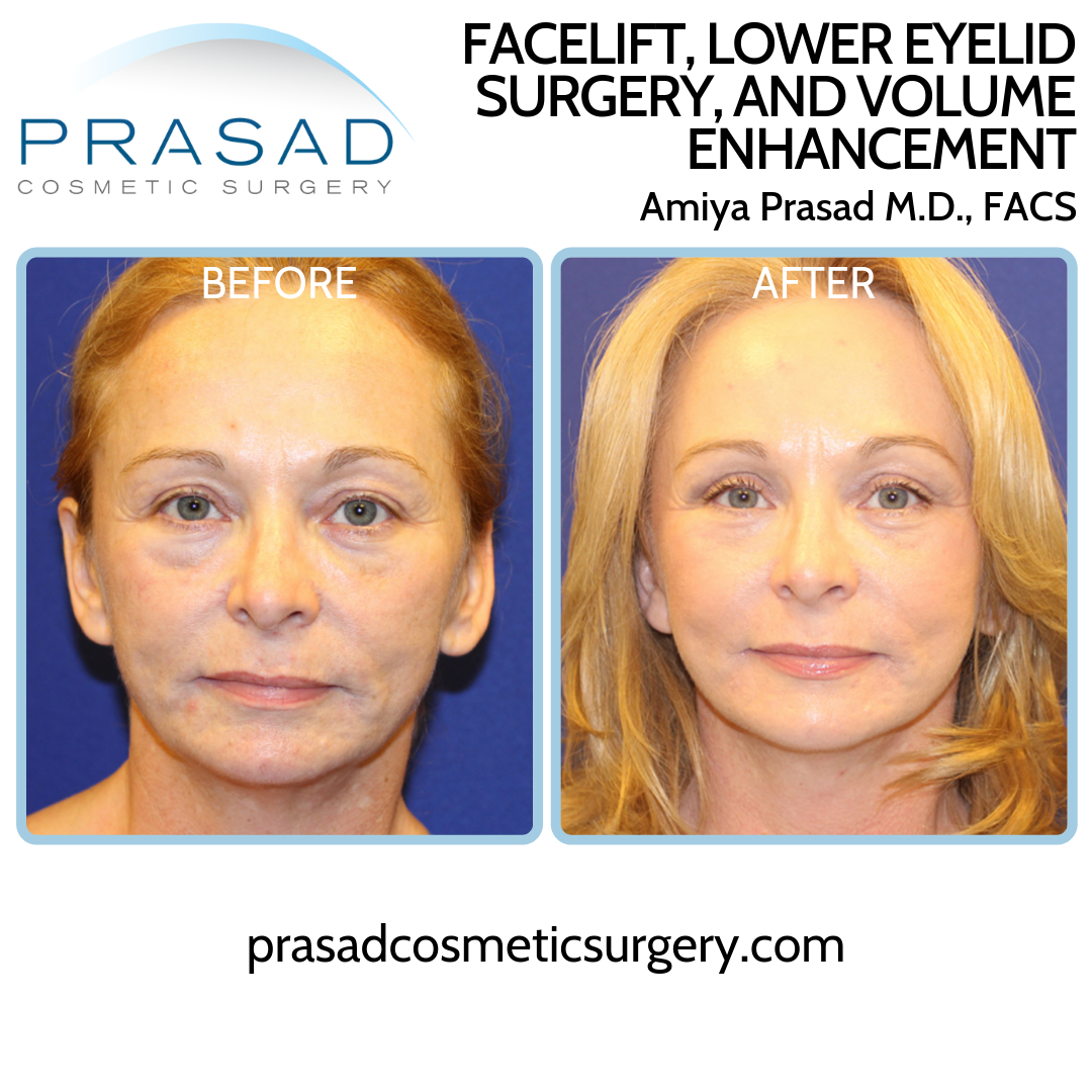 Facelift Patient Before and After - front view