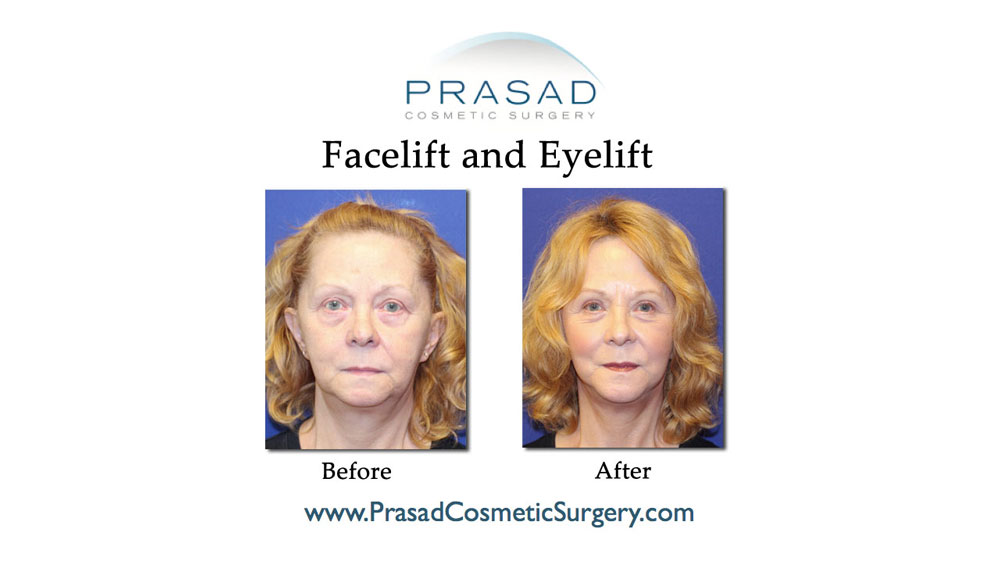 facelift and eyelift before and after 70 yrs old