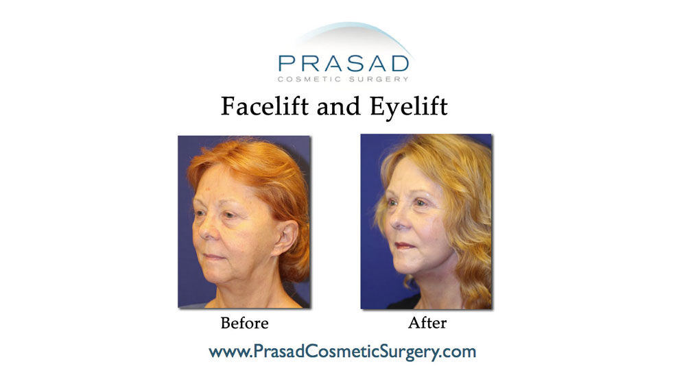 before and after plastic surgery new york