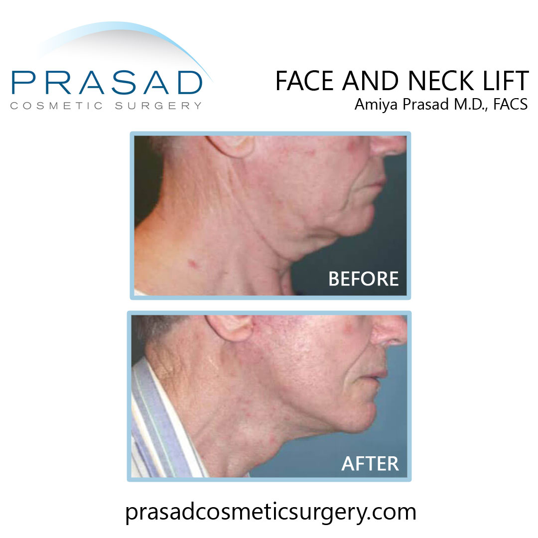 face and necklift results before and after recovery
