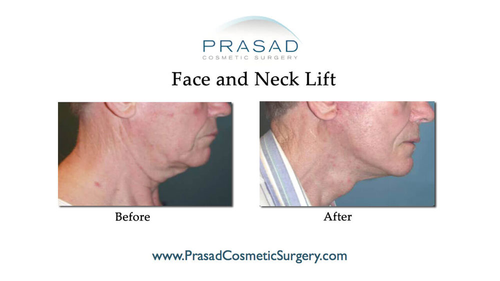 face and necklift results beefore and after recovery