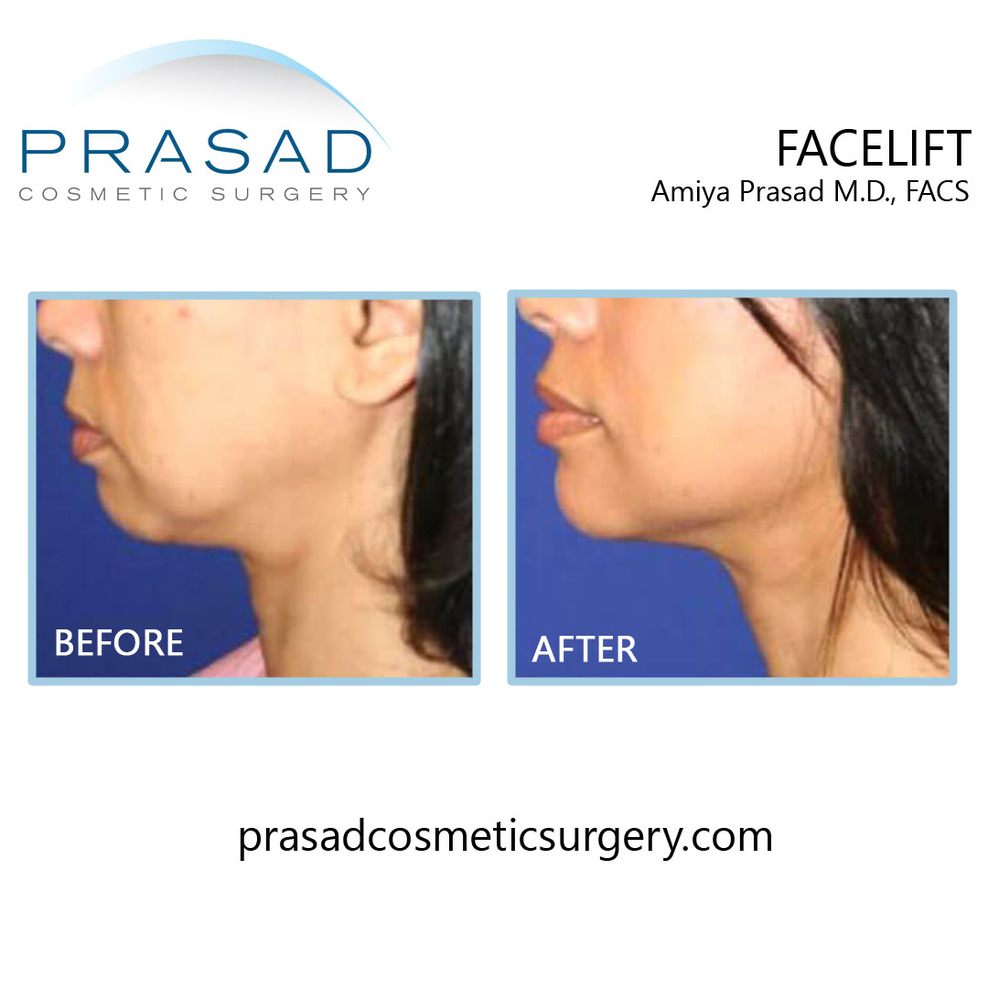before and after facelift recovery