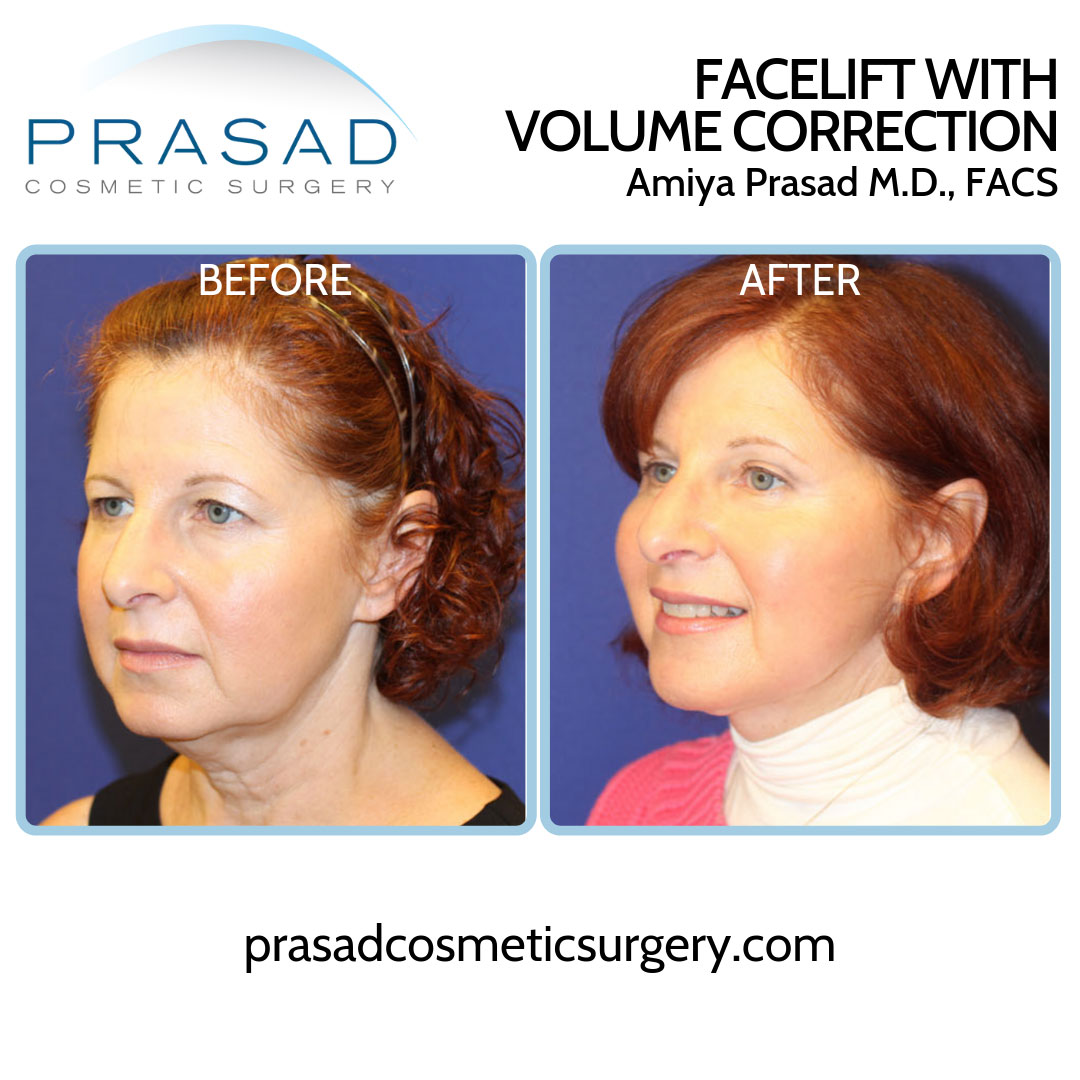 before and after facelift with volume correction