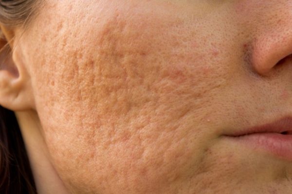 Acne scars on female right cheek