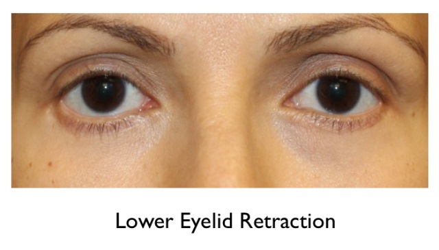 lower eyelid retraction female