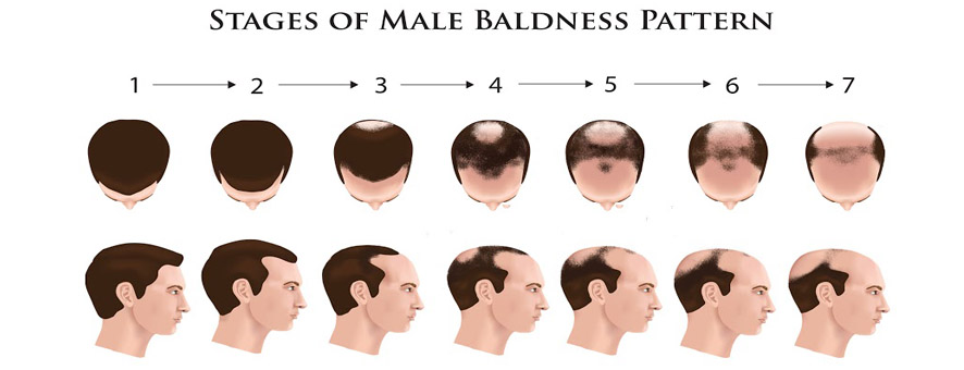 hair loss stages of men illustration