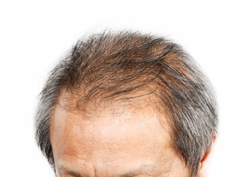 older man with hair loss problem model