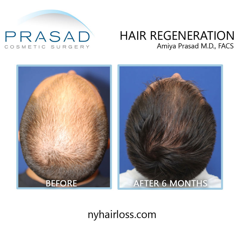 Before and 6 months after hair regeneration treatment on male patient top of the head view