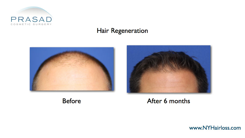 Before and after non-surgical hair loss treatment - male patient front view