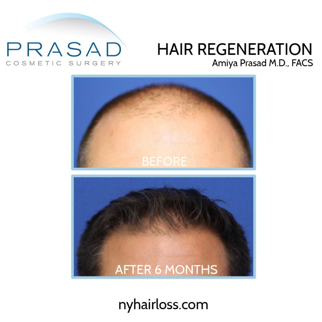 Before and after non-surgical hair loss treatment - male patient front view