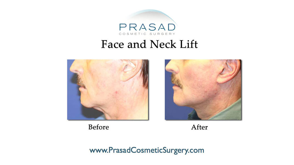 Before and after mini facelift results - male patient