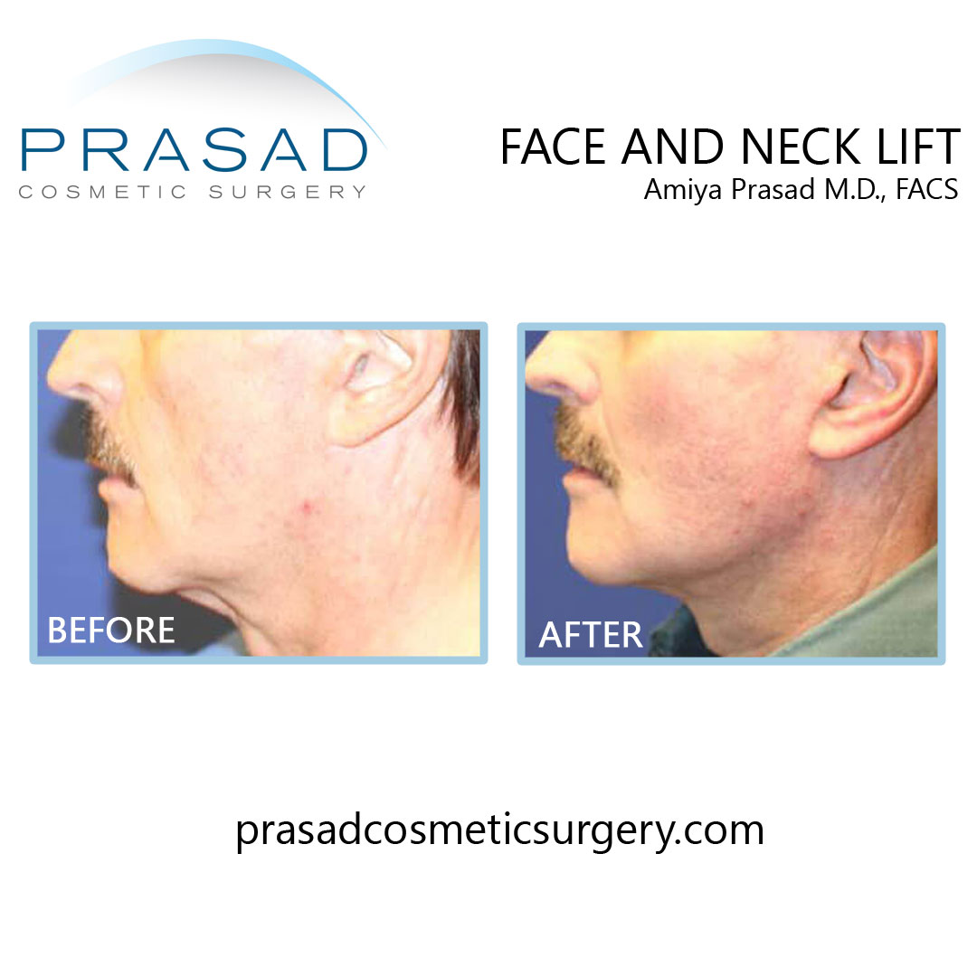 before and after facelift and neck lift - male patient side view