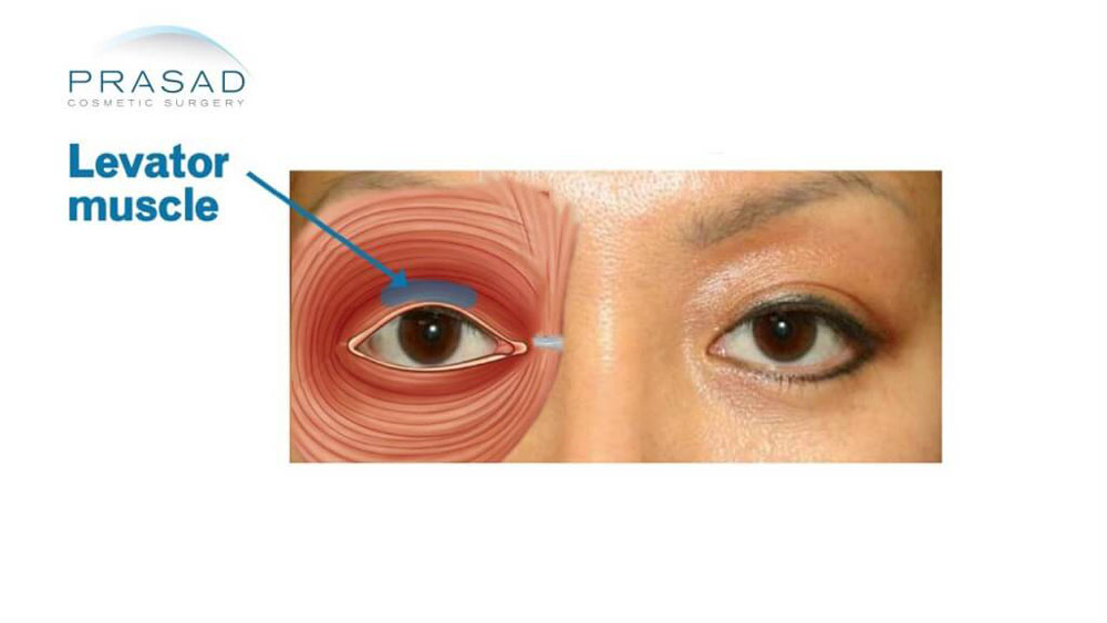 Droopy eyelid-levator muscle illustration