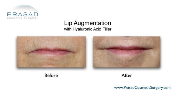 fillers for lips before and after