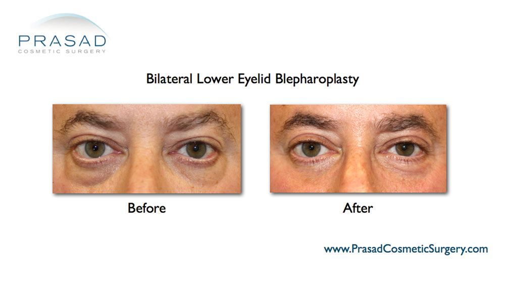 male eye bags surgery before and after