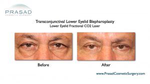 Laser Treatment For Dark Circles Under Eyes | Dr. Prasad Blog