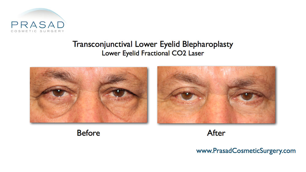 Eye Lift Before and After Photos | Prasad Cosmetic Surgery NY