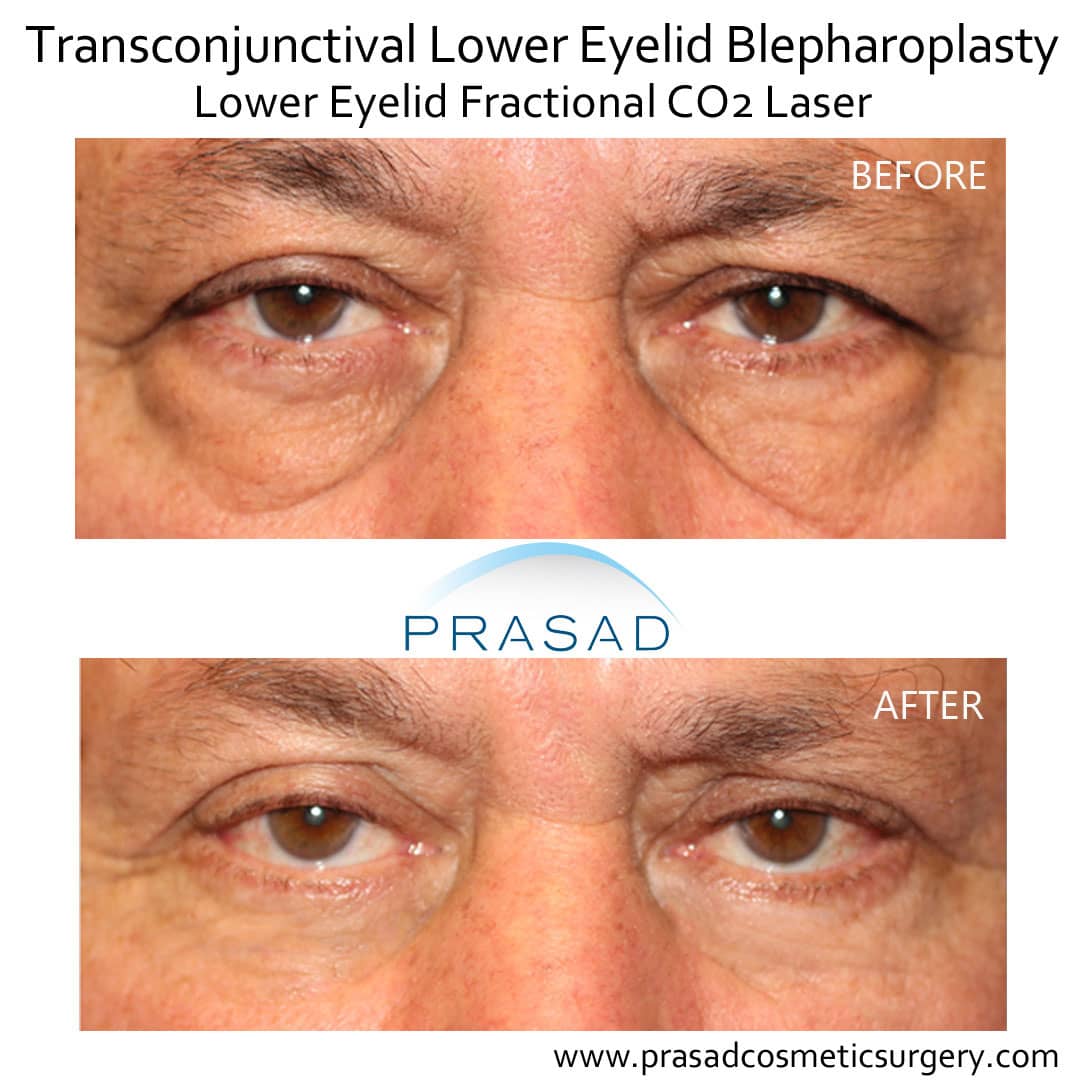 male eye bags surgery with laser and prp under eyes before and after by Dr Amiya Prasad New York office