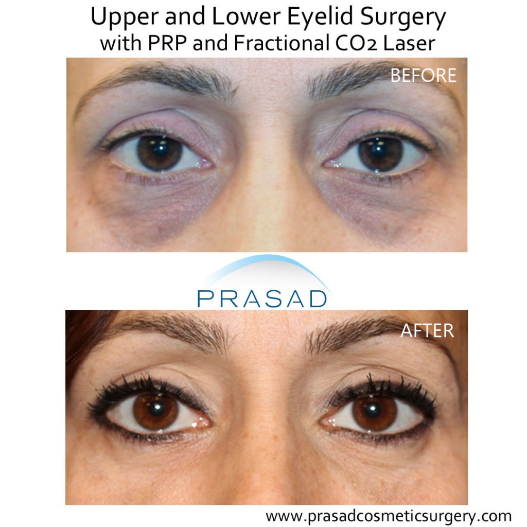 Pre and post procedure photographs of fractional CO2 laser withprp patients